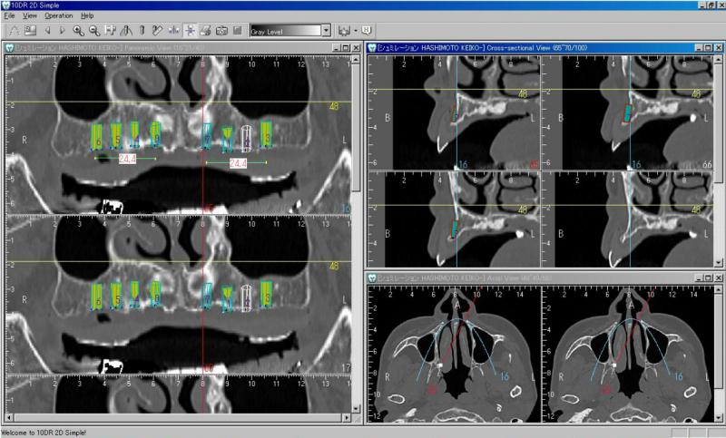 上の顎にどの位置にインプラントが入るか、CTという奇怪で3次元的に調べます。