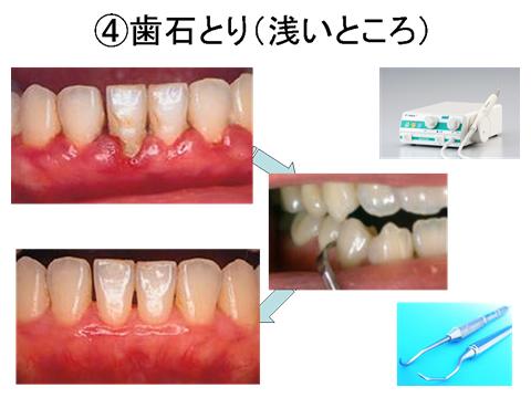 歯石取り 悪 除去 歯石とり