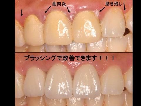 レーザーとセラミック  小樽 熊澤歯科クリニック